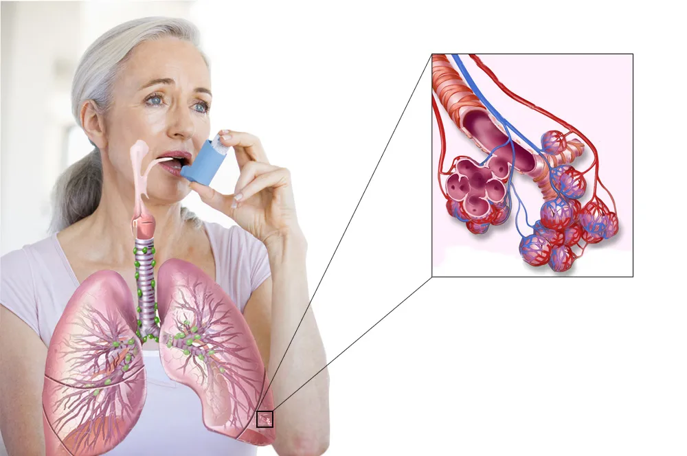 
											
											Сўнгги йилларда астма касаллигидан вафот этганлар кўпайган
											
											