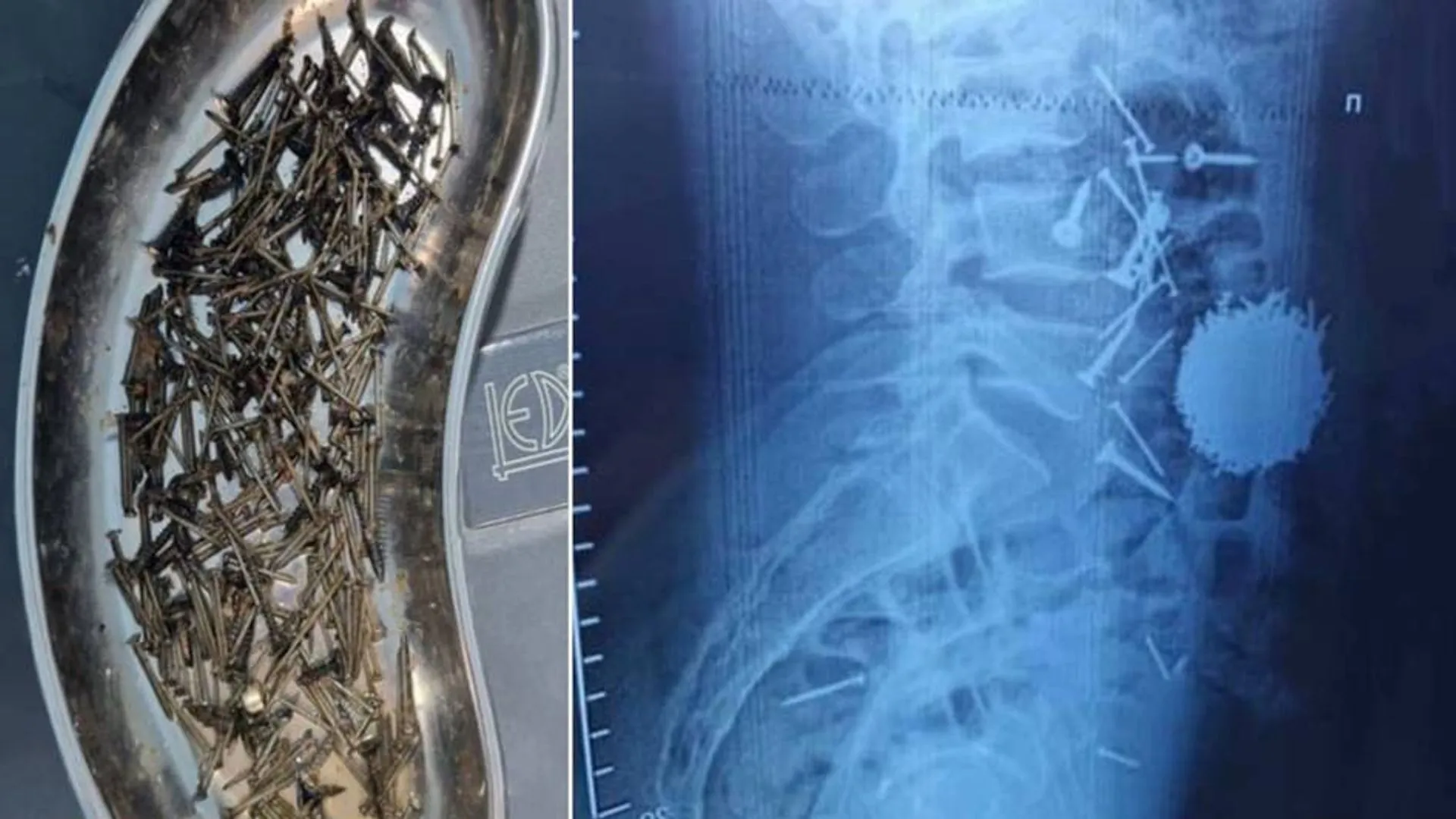 
														
														Самарқандда эркак 200 грамм михни ютиб юборди
														
														